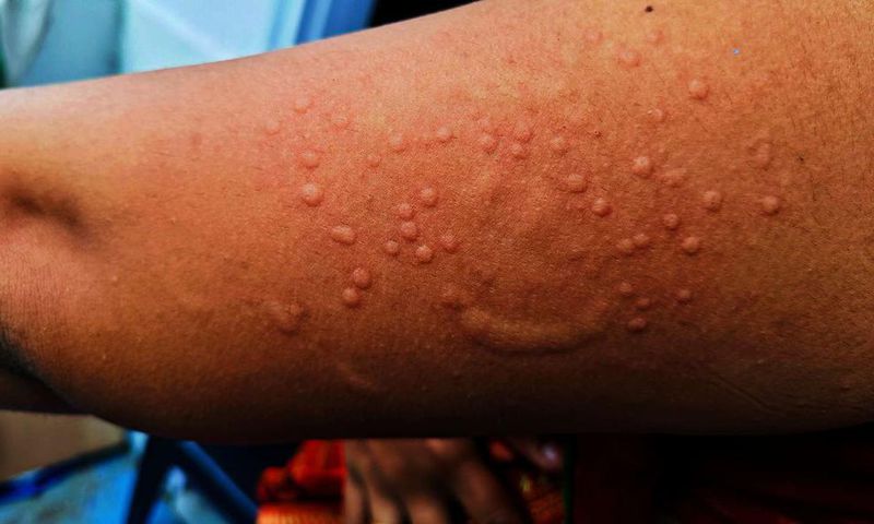 Monkeypox