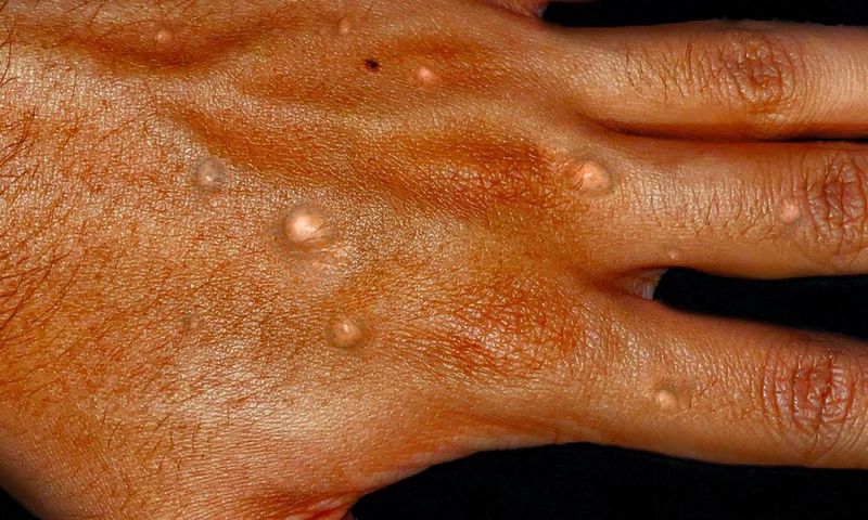 Monkeypox on a hand-Healthdirect