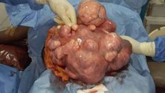 Fibroids
