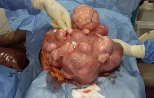 Fibroids