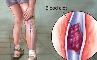 Deep vein thrombosis (DVT)