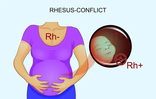 RH incompatibility sounds like a huge problem but it's not a death sentence