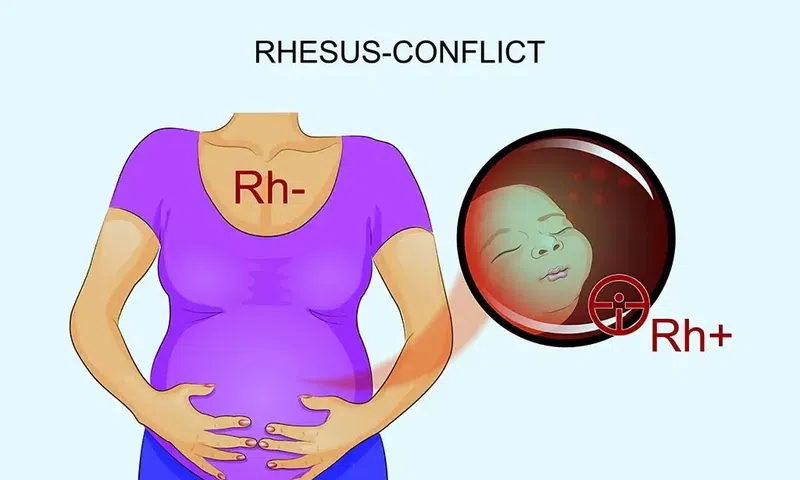 RH incompatibility sounds like a huge problem but it's not a death sentence