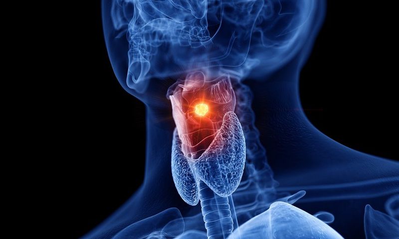Doctors report a troubling increase in throat cancer cases among younger patients, attributing this trend to the prevalence of oral sex.