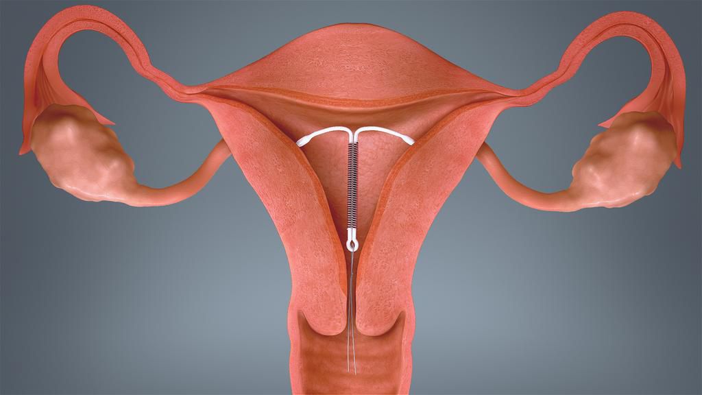 IUD in uterus(Scientific Animations)