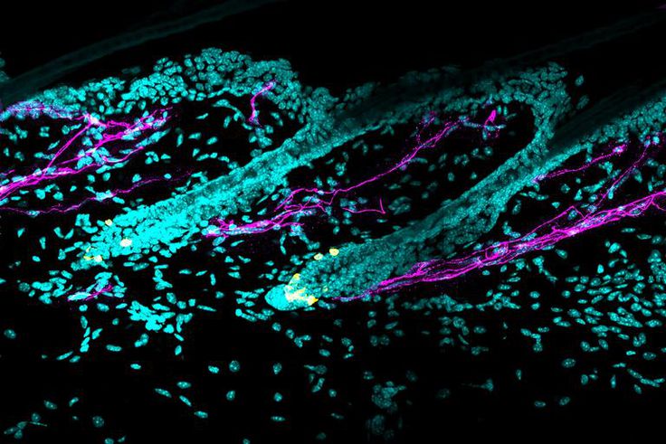 Stress Really Does Make Hair Go Gray Faster