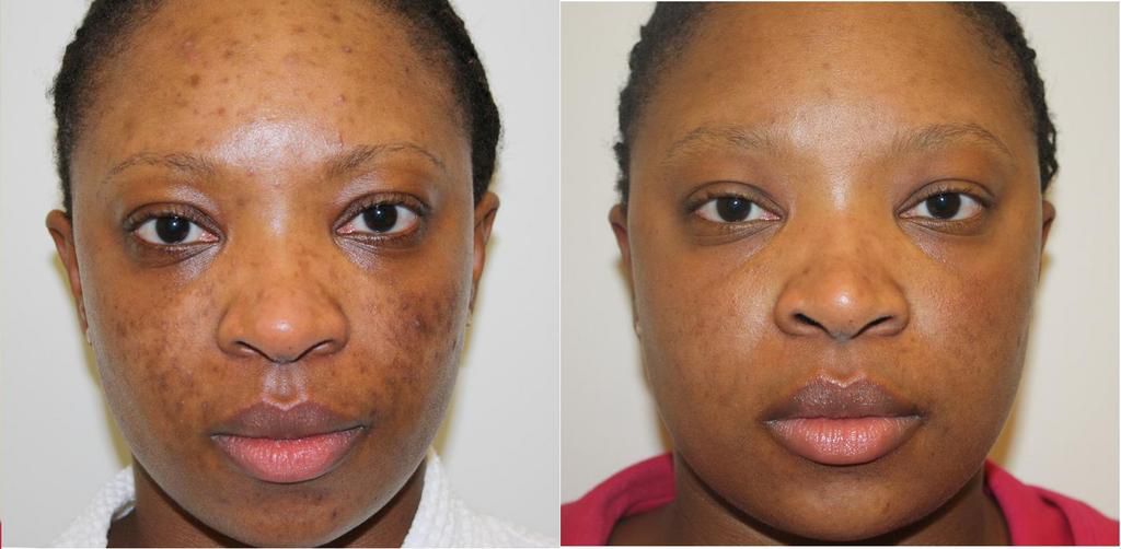 A blemished skin shows improvement after treatment