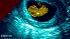 What do new state abortion laws really mean for women?