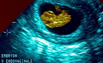 What do new state abortion laws really mean for women?