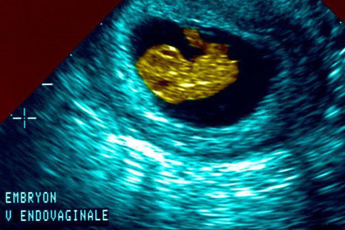 What do new state abortion laws really mean for women?