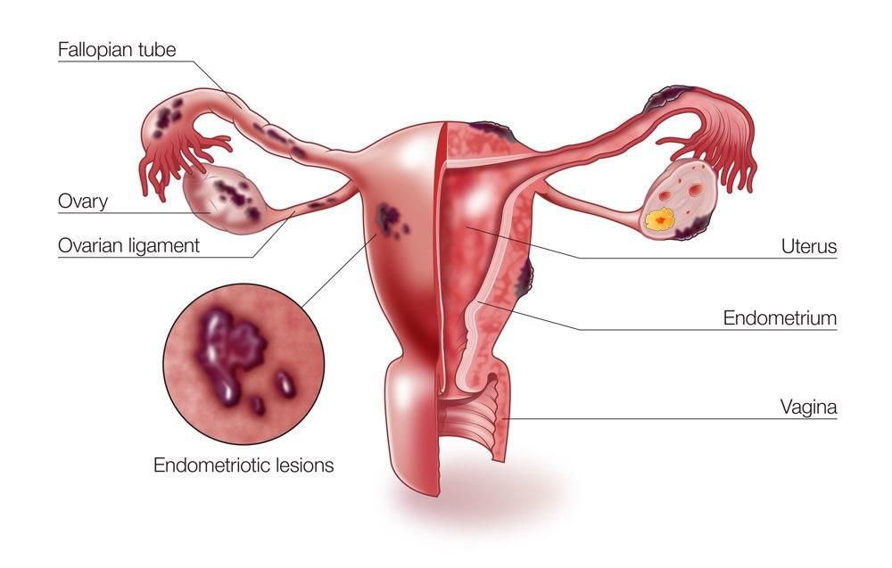 A diagram showing how endometriosis occurs in female reproductive organs