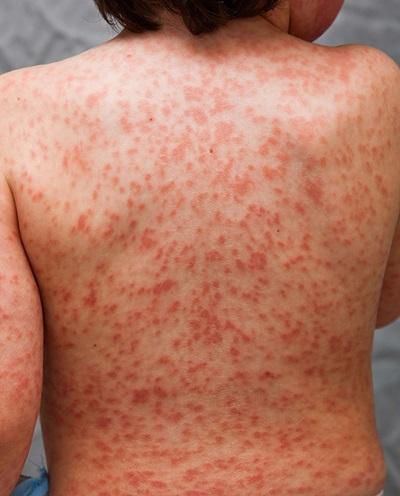 Children affected by strange disease linked to Covid-19