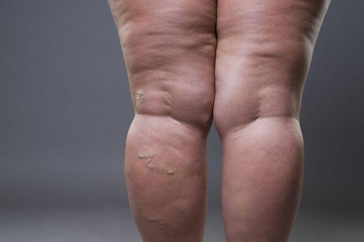 Habits that cause cellulite(inquisitr)