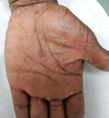 Rashes on the hand (MDedge)