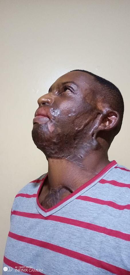 I went on Facebook Live to commit Suicide- Acid attack survivor Kelvin Kairo tells it all