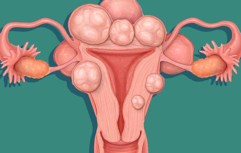 Uterine fibroids