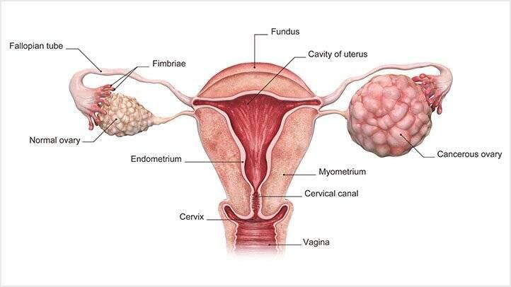 Ovarian cancer(everydayhealth)