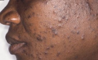 Acne(standardmedia)