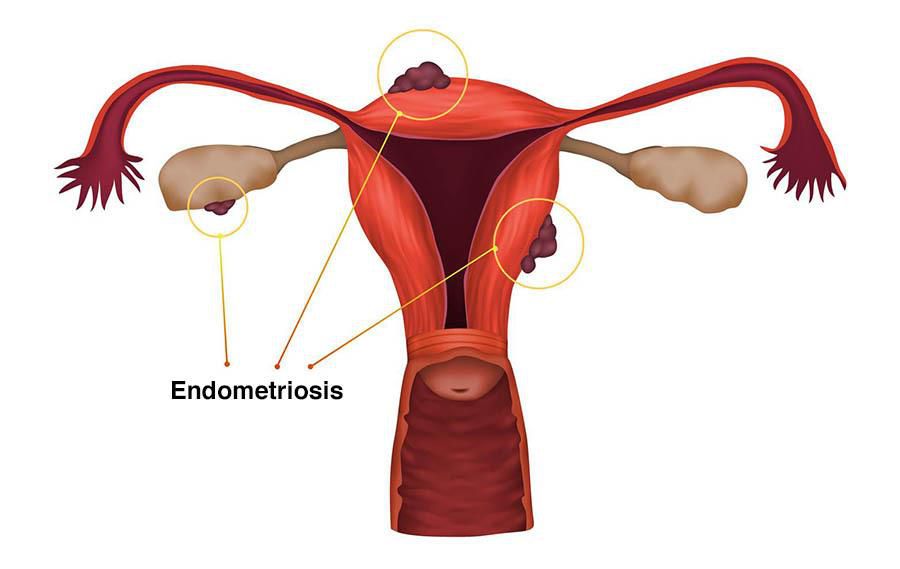 Endometriosis illustration(HealthDirect)