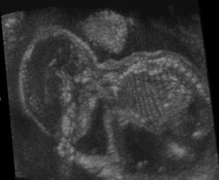 A scan of a foetus