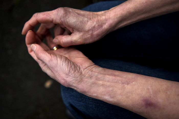 At 71, She's Never Felt Pain or Anxiety. Now Scientists Know Why.