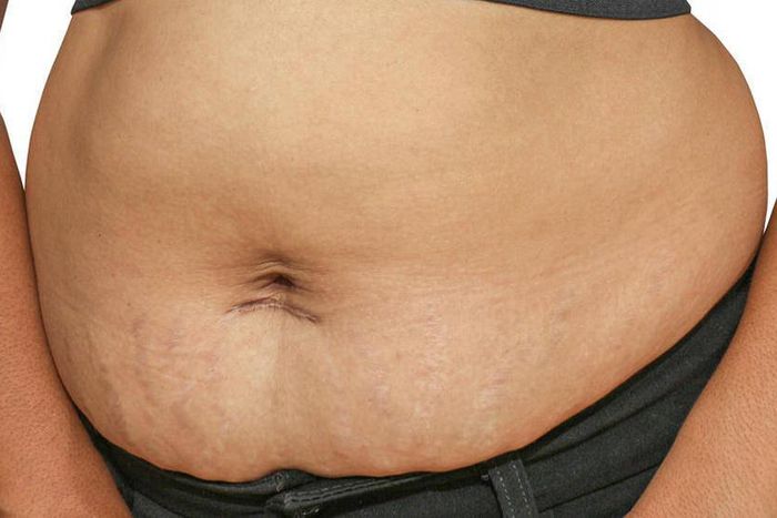 Post baby belly (BabyCentre)