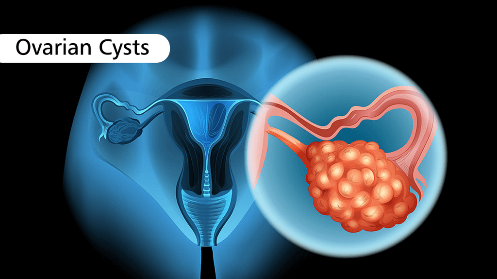 Causes of ovarian cysts(MaxCure Suyosha Hyderabad)