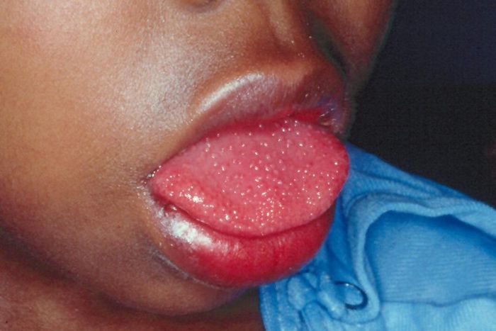 Children affected by strange disease linked to Covid-19