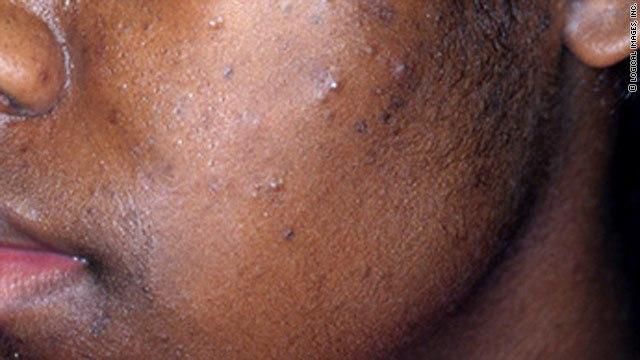 ___7917197___2018___1___31___12___t1larg.acne.logical