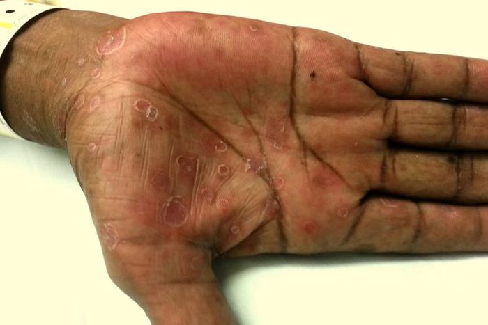 hand rash (Academic Life in Emergency Medicine)