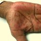 hand rash (Academic Life in Emergency Medicine)