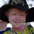 An albino girl smiles in Mitindo Primary School in Nyawilimilwa, Mwanza region of Tanzania, in a file photo. REUTERS/Katrina Manson