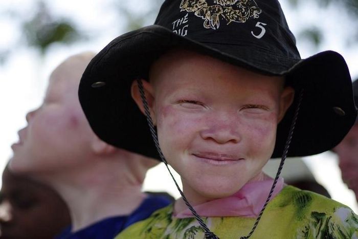 An albino girl smiles in Mitindo Primary School in Nyawilimilwa, Mwanza region of Tanzania, in a file photo. REUTERS/Katrina Manson