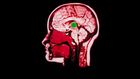 Doctors use electrical implant to aid brain-damaged woman