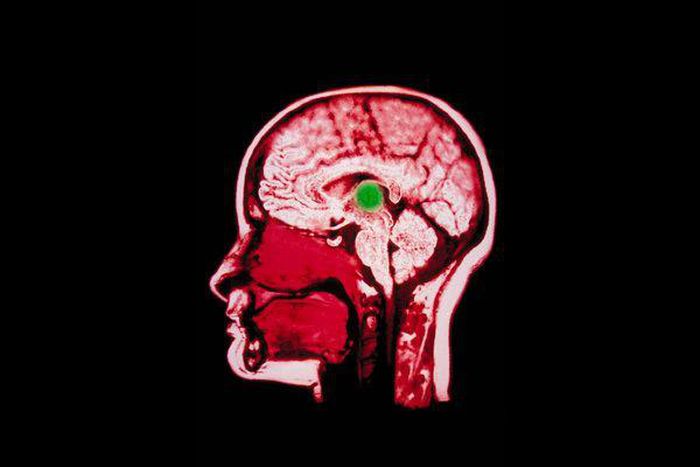 Doctors use electrical implant to aid brain-damaged woman