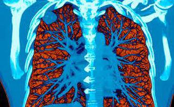AI took a test to detect lung cancer, it got an A