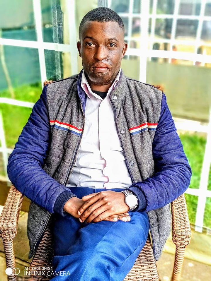 I went on Facebook Live to commit Suicide- Acid attack survivor Kelvin Kairo tells it all