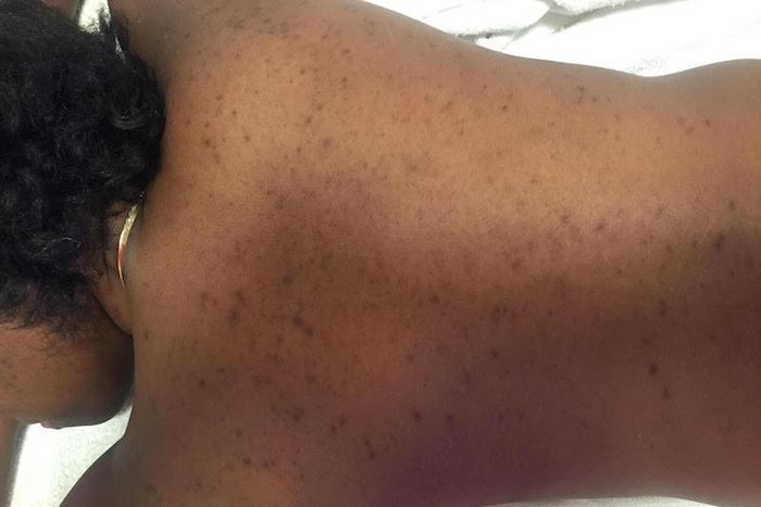 What your acne means (Elite Daily)