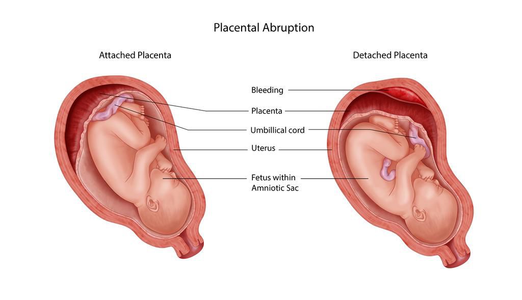 Placental Abruption(New Mums Hub)
