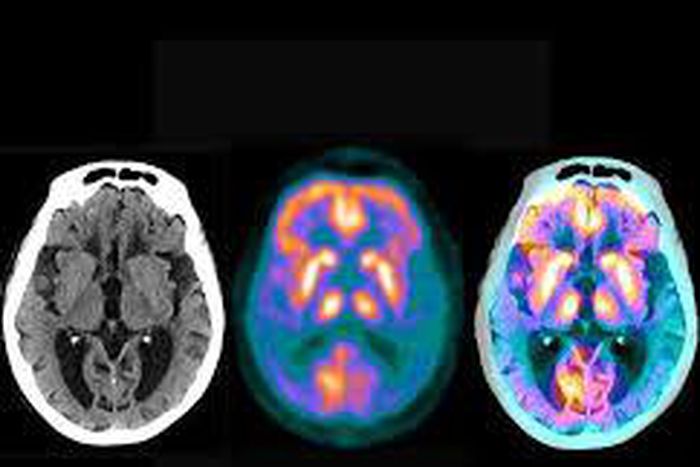 Study offers hint of hope for staving off dementia in some people