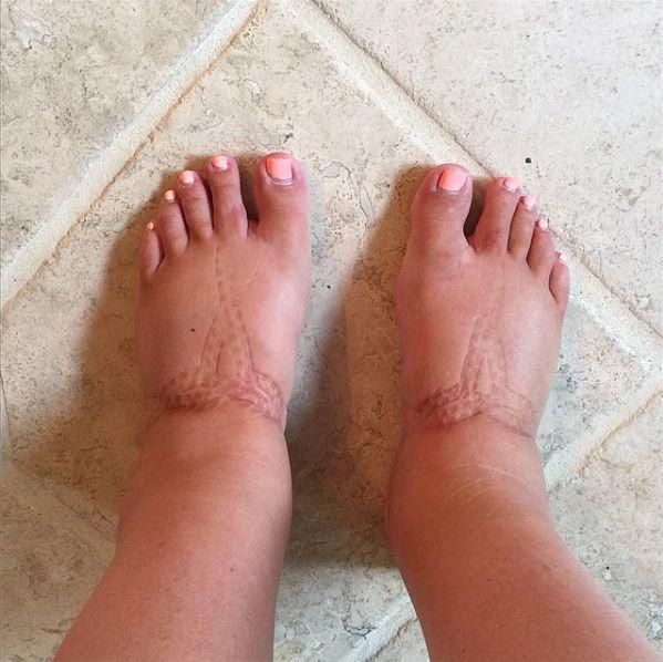 swollen feet(Bloglovin)