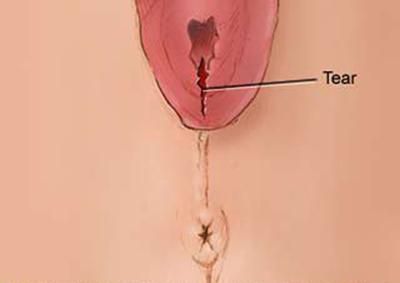 Minor vaginal tear(The Skeptical OB)
