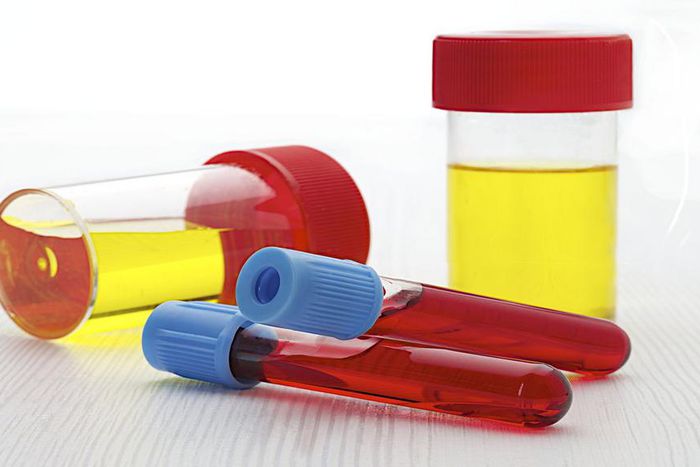 Causes of blood in urine(healthhearty)