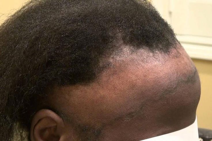 Hair loss (wwwlearnbemobile)