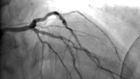 Surgery for Blocked Arteries Is Often Unwarranted, Researchers Find