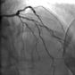 Surgery for Blocked Arteries Is Often Unwarranted, Researchers Find