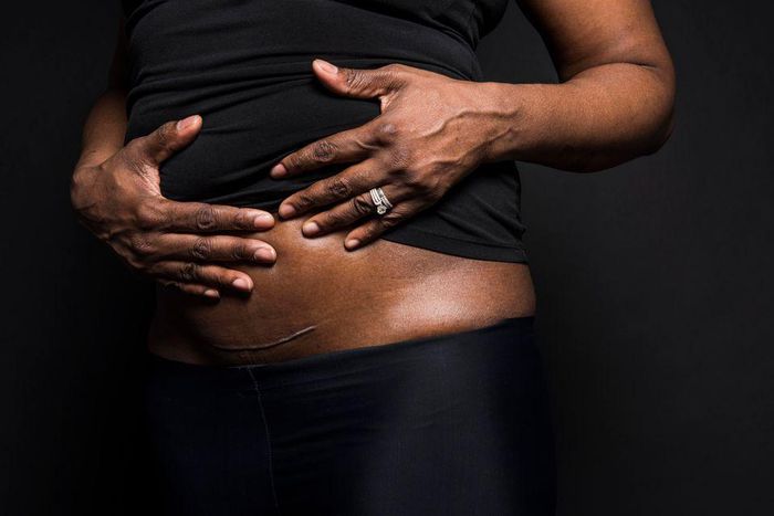 C-section scar (HuffPost)