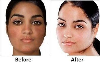 Skin 'bleaching'