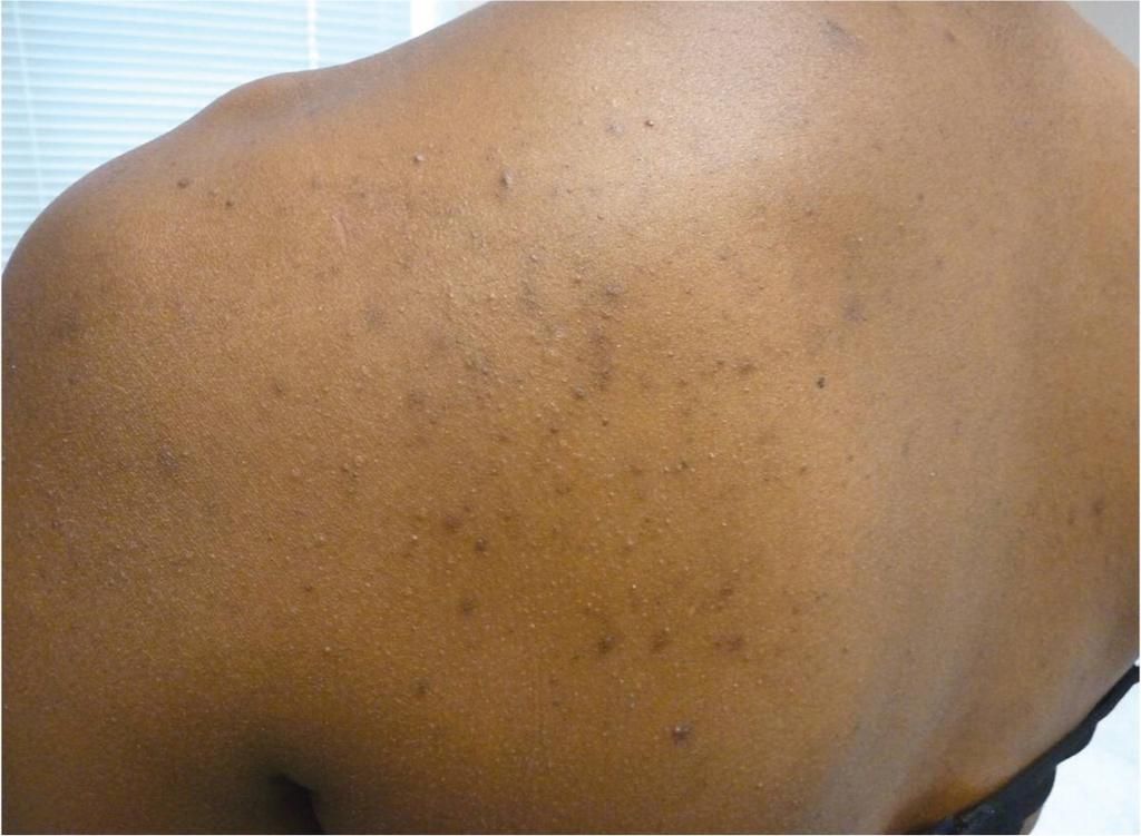 Back acne (Aafp)