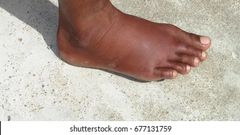 Exercises that reduce leg swelling [shuttershock]